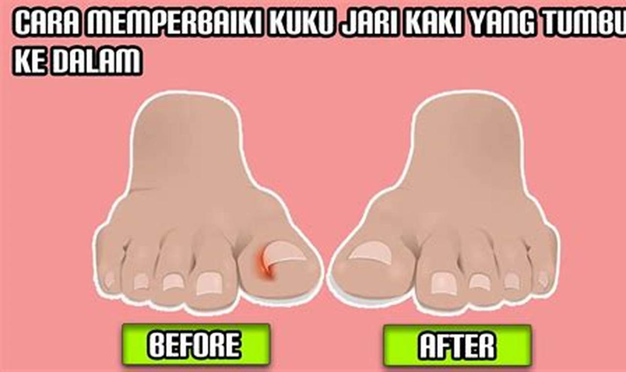 Cara Mengatasi Kuku Cantengan